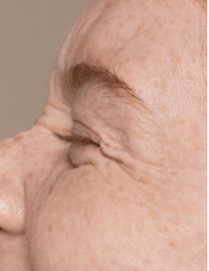 1759514281 963 Top 5 Deep Wrinkle Creams Fillers That Are Worth
